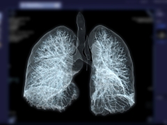  A low-dose CT scan of the lungs. 